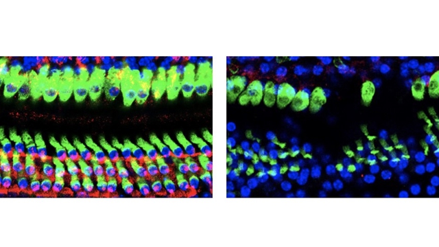 Metformin May Hold Key to Preventing Age-Related Hearing Loss