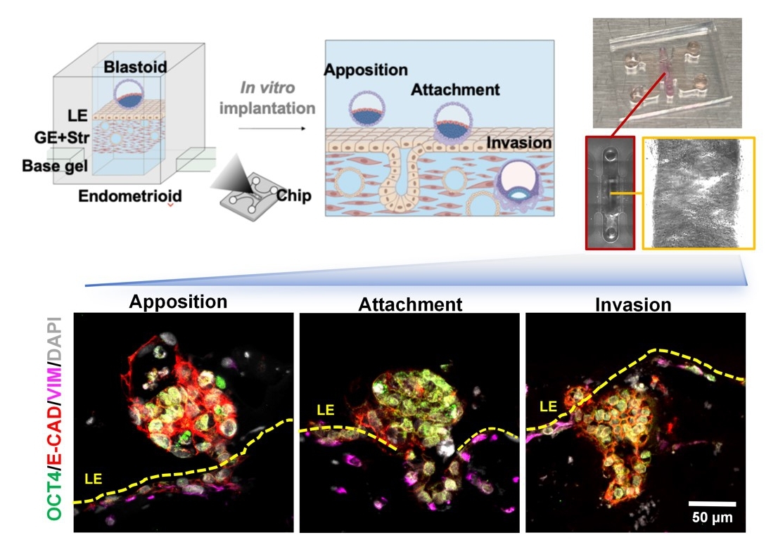 3D Uterine Embryo Implantation Simulating Chip Cracks the Code of Repeated Implantation Failure